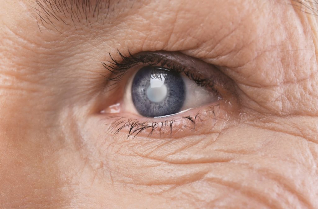 A close up of an older person's eye suffering from glaucoma
