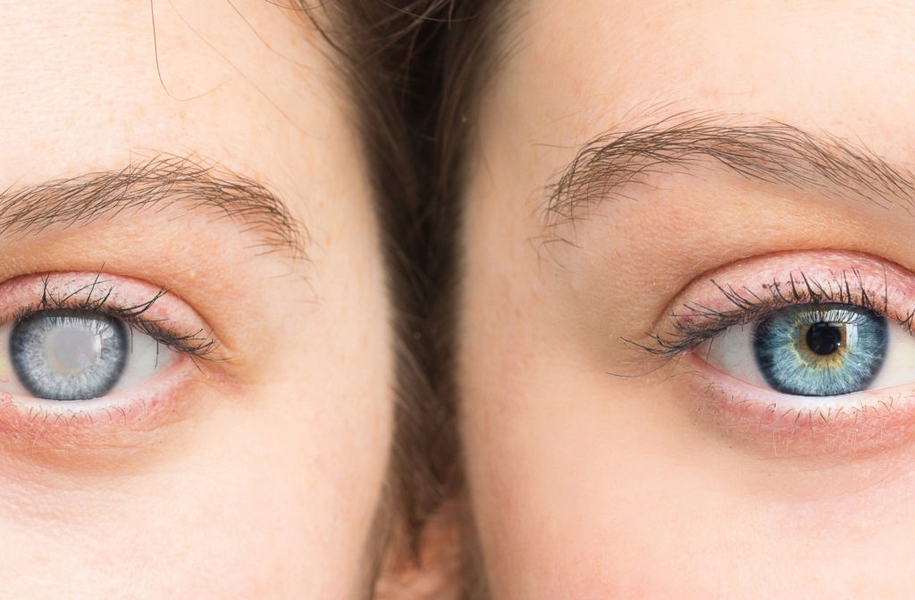 A close-up comparison of two eyes: the one on the left has cataracts, while the one on the right appears healthy.