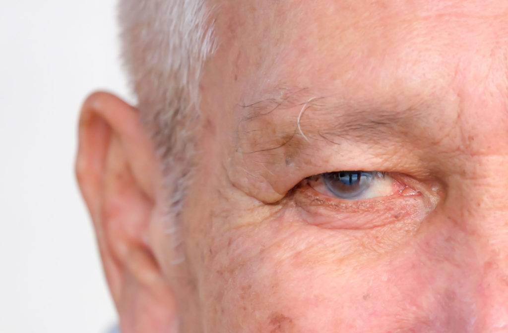 A close-up of a senior man showing signs of glaucoma.