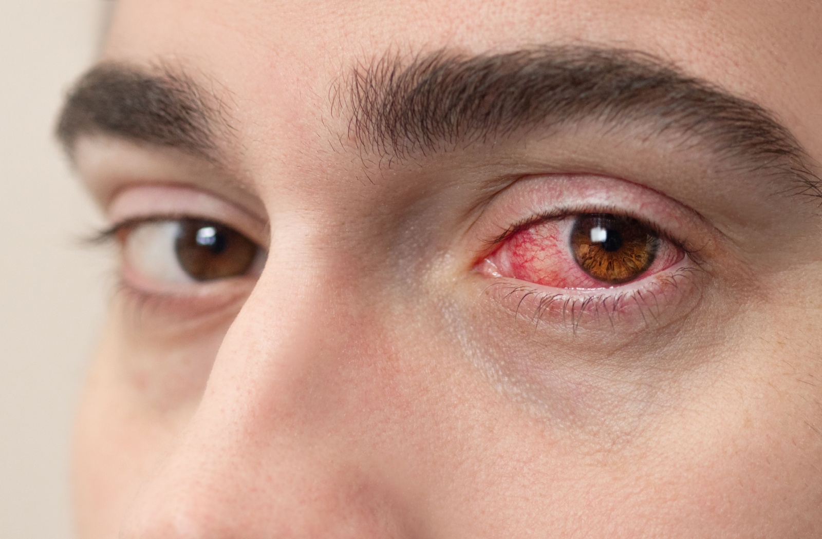 A close-up image of a patient's eyes with inflammation and redness due to pink eye.